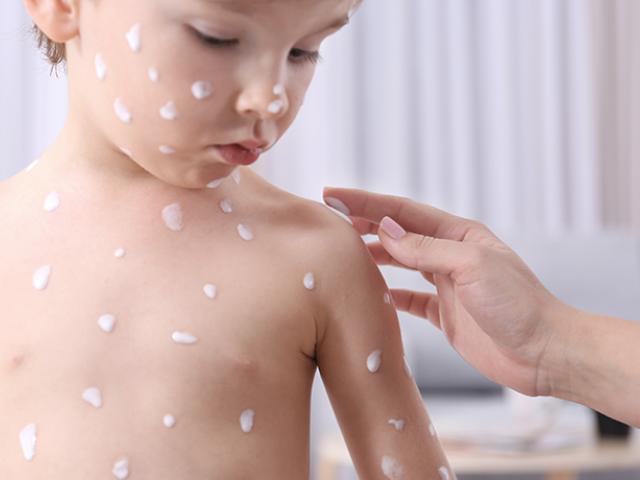 Aplicando crema a niño con varicela