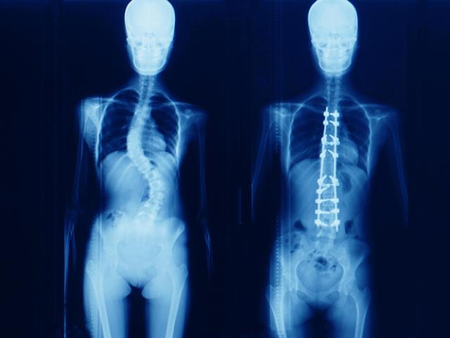 La escoliosis es una curvatura anormal de la columna vertebral